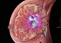 La cura del cáncer sin quimioterapia