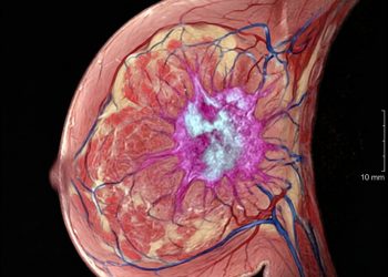 La cura del cáncer sin quimioterapia