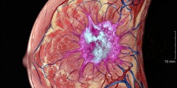 La cura del cáncer sin quimioterapia